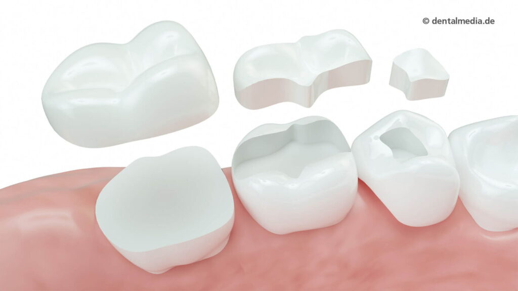 Inlays, Onlays, Overlays — Zahnästhetik in Troisdorf